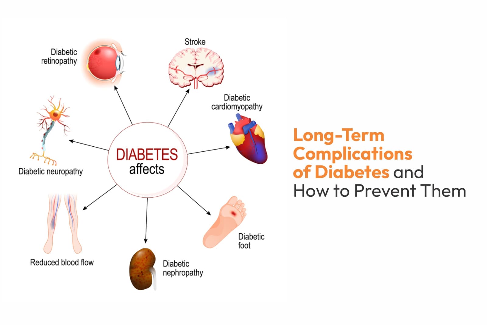 Long-Term Complications of Diabetes and How to Prevent Them
