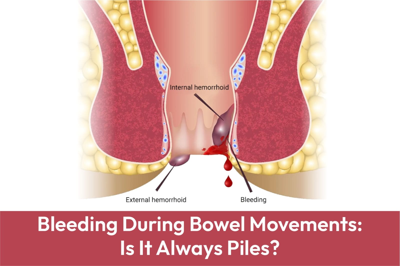 Bleeding During Bowel Movements: Is It Always Piles?
