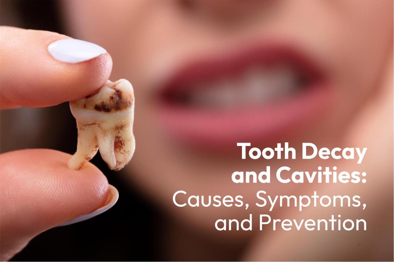 Tooth Decay and Cavities: Causes, Symptoms, and Prevention