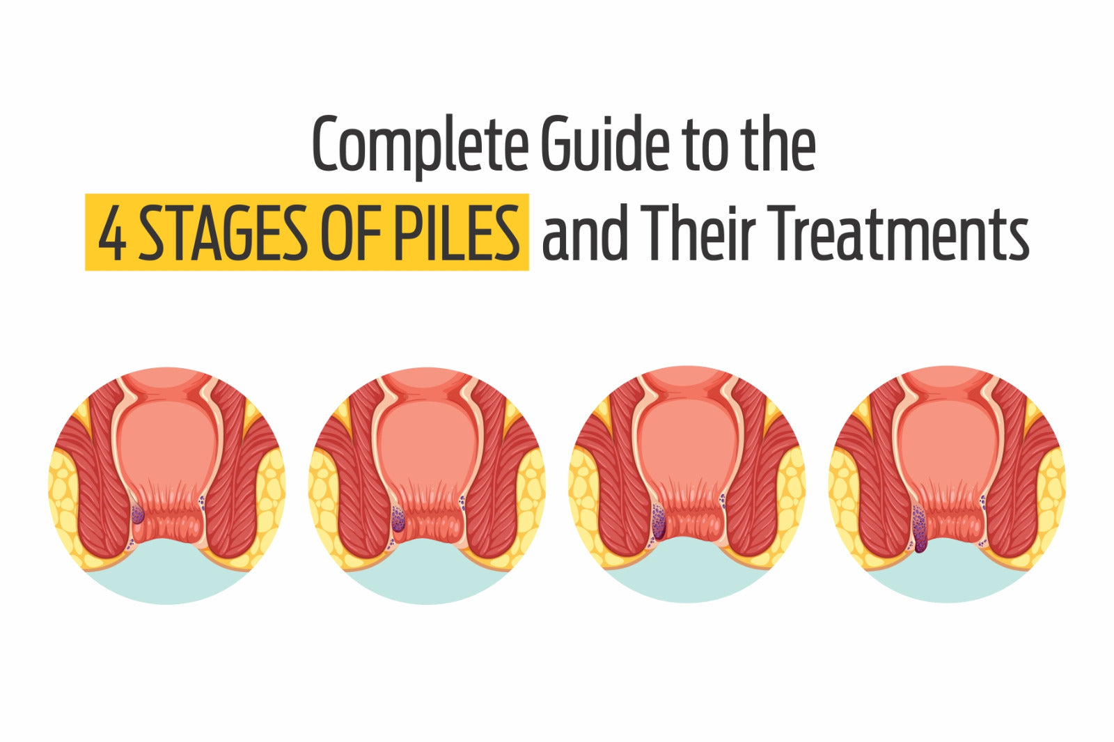Complete Guide to the 4 Stages of Piles and Their Treatments